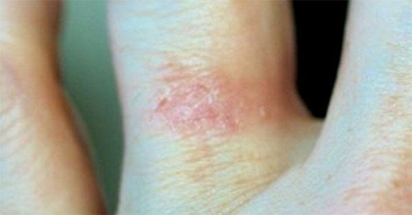 Image showing a skin rash on a finger where a ring has been worn